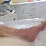 administracion-ulceras